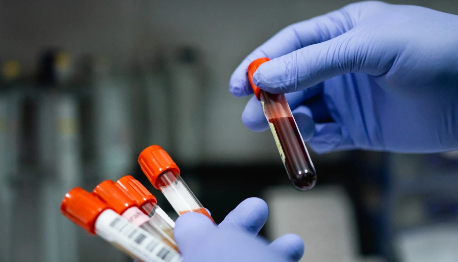 "Centrālās laboratorijas" filiālēs bez maksas var nodot C hepatīta analīzes